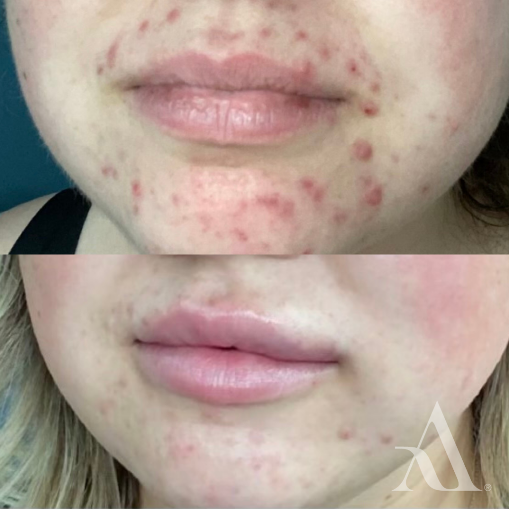 Morpheus8 Before and After treatment of skin tightening and reduction of active acne and active scarring 